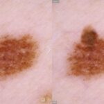 dermatoscopia